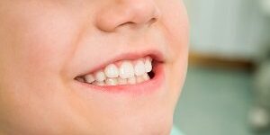 Smile of boy How You Can Prevent Your Toddler’s Tooth Decay