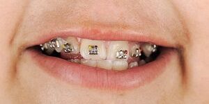 Kid showing off his braces orthodontics