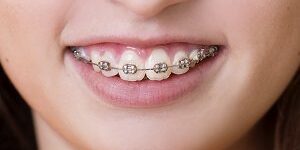 Dental visit Choosing color for braces
