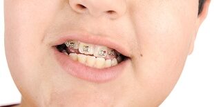 Kid showing off his braces misalignment, teeth