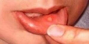 cankersore canker sores, pediatric canker sore, pediatric dentist, pediatric dentist san diego, kid's dentist san diego