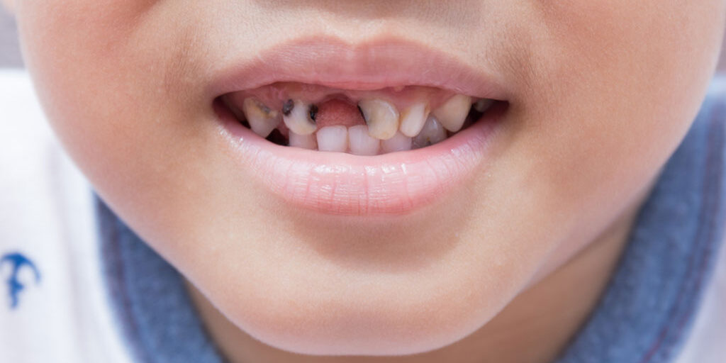Tooth decay in children
