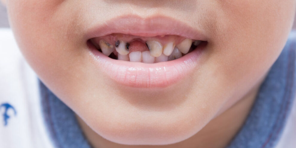 Tooth decay in children Tooth decay in children