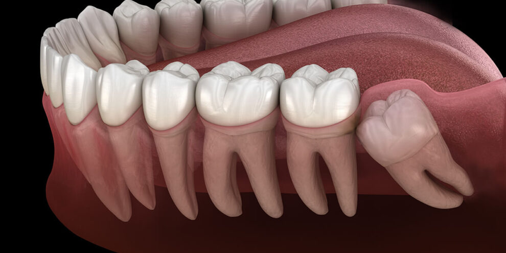 Wisdom Teeth Removal Wisdom Teeth Removal